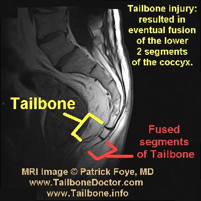 Tailbone MRI (Coccyx MRI)