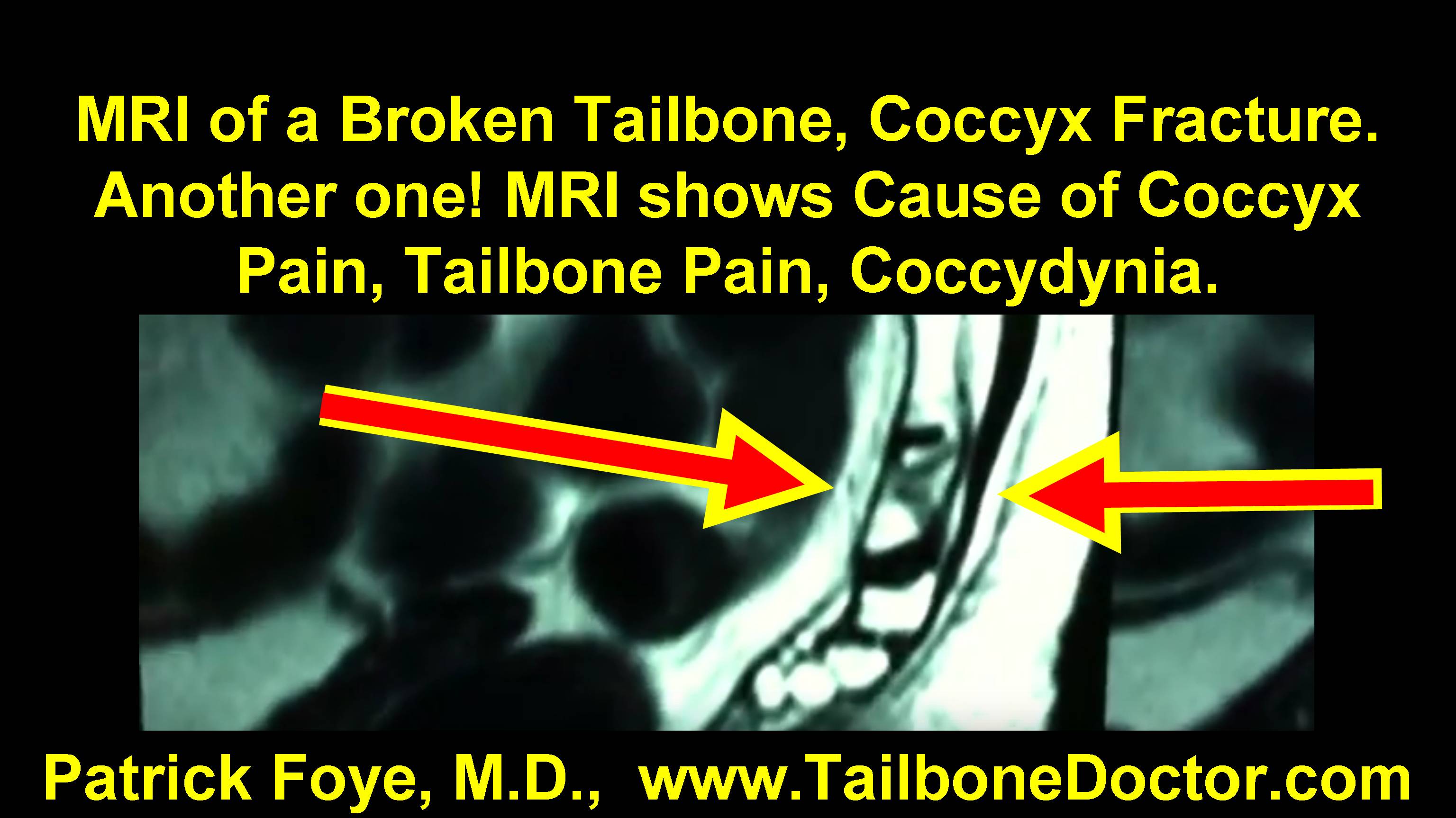 Can You Walk With A Broken Tailbone Blog On Tailbone Pain Coccyx Pain Tailbone Doctor Part 10