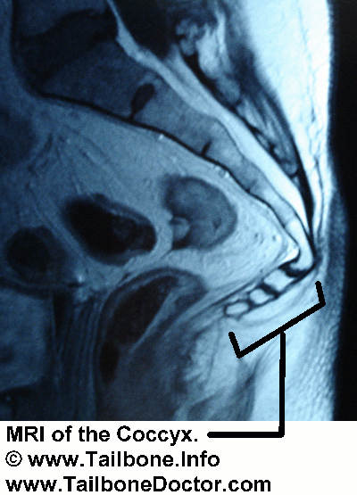 Tailbone coccyx dislocation injury