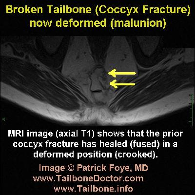 Tailbone MRI, Coccyx MRI, tailbone pain, injury