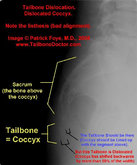 X-ray of a TAILBONE DISLOCATION, DISLOCATED COCCYX. 