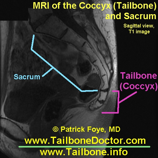 Tailbone MRI, Coccyx MRI, Tailbone Pain, injury