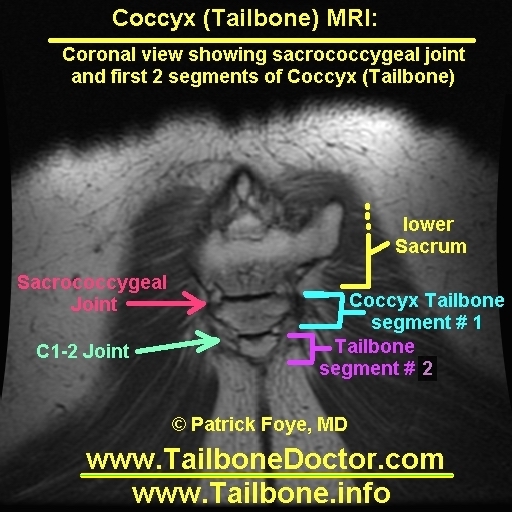 Tailbone MRI, Coccyx MRI, Tailbone Pain, Coccyx injury
