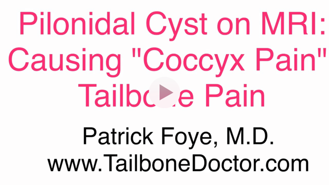 MRI of Pilinidal Cyst, Coccyx Pain, Tailbone pain