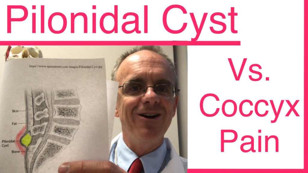 Pilonidal Cyst vs Tailbone Pain, Coccyx Pain, Screen Shot
