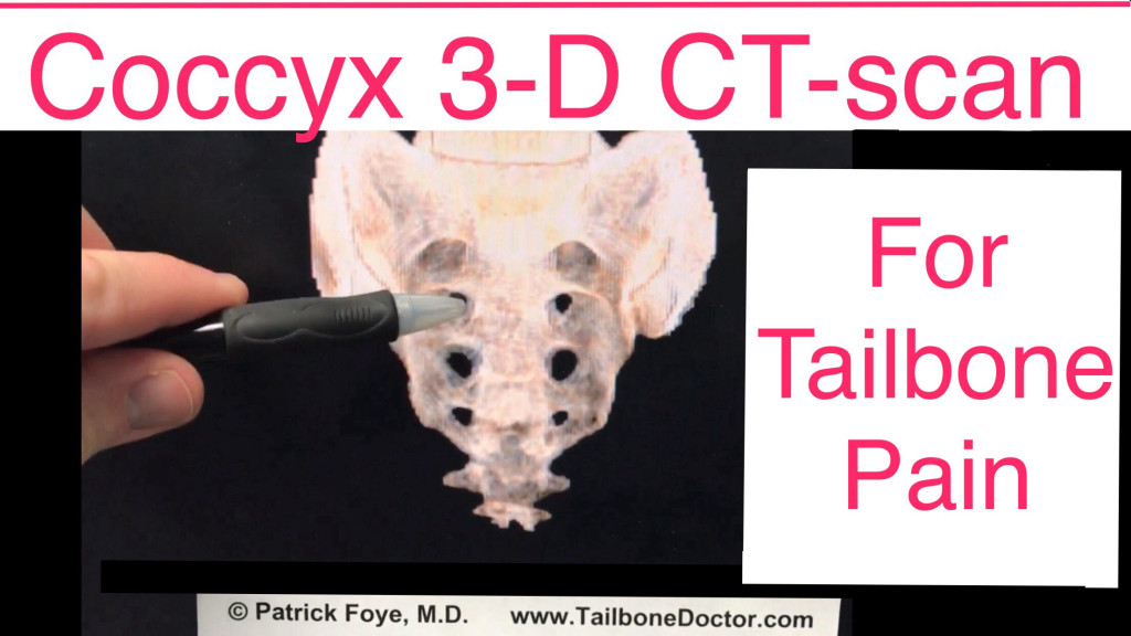 3D CT-scan for Tailbone Pain, Coccyx Pain