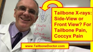 Tailbone X-rays, Side-View versus Front View, for Tailbone Pain, Coccyx Pain,