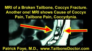 MRI of a Broken Tailbone, Coccyx Fracture, Coccyx Pain, Tailbone Pain, Coccydynia