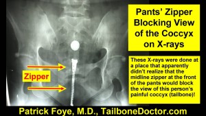 Pants Zipper Blocks View of the Coccyx, Tailbone, on Xrays