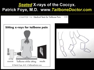 Sit-Stand X-rays show SEVERE Dislocation only seen on SEATED xrays done for   tailbone pain, coccyx pain, coccydynia