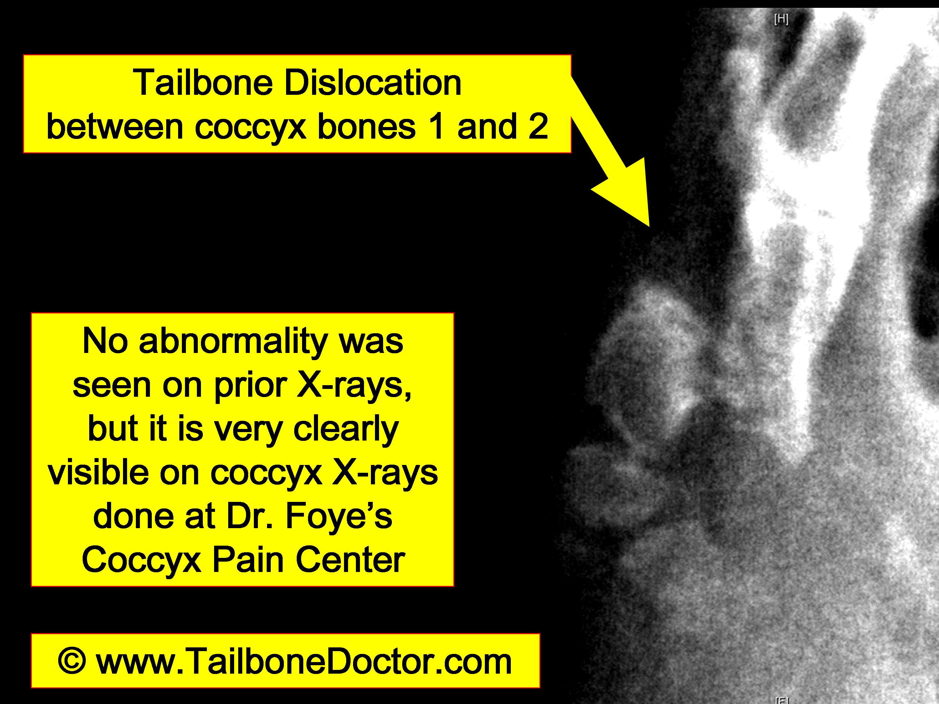 Fractured Tailbone Pain Relief - Beacon Orthopaedics